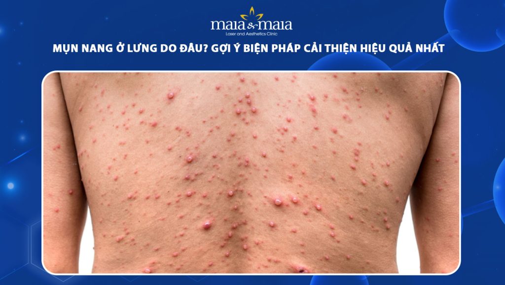 Mụn nang ở lưng do đâu? Gợi ý biện pháp cải thiện hiệu quả 1 mụn nang ở lưng