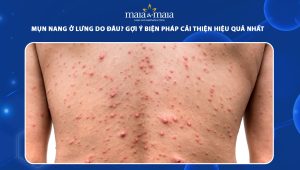 mụn nang ở lưng