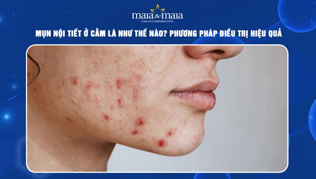 Mụn nội tiết ở cằm là như thế nào? Cách điều trị hiệu quả 1 Mụn nội tiết ở cằm