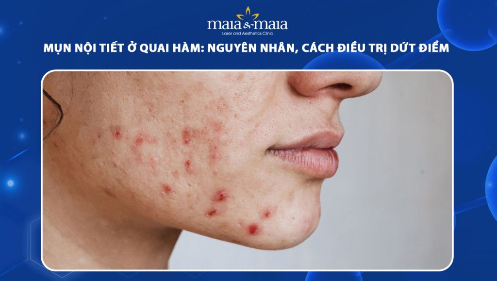 Mụn nội tiết ở quai hàm: Nguyên nhân, cách điều trị dứt điểm 1 mụn nội tiết ở quai hàm