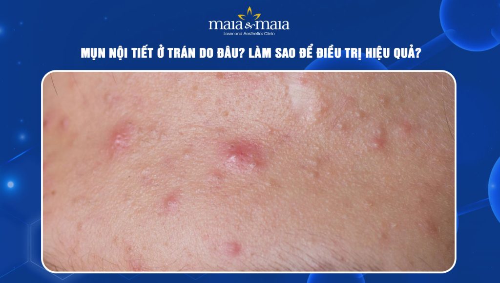 Mụn nội tiết ở trán do đâu? Làm sao để điều trị hiệu quả? 1 Mụn nội tiết ở trán