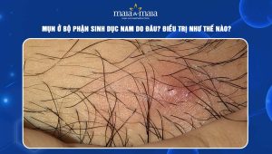 Mụn ở bộ phận sinh dục nam