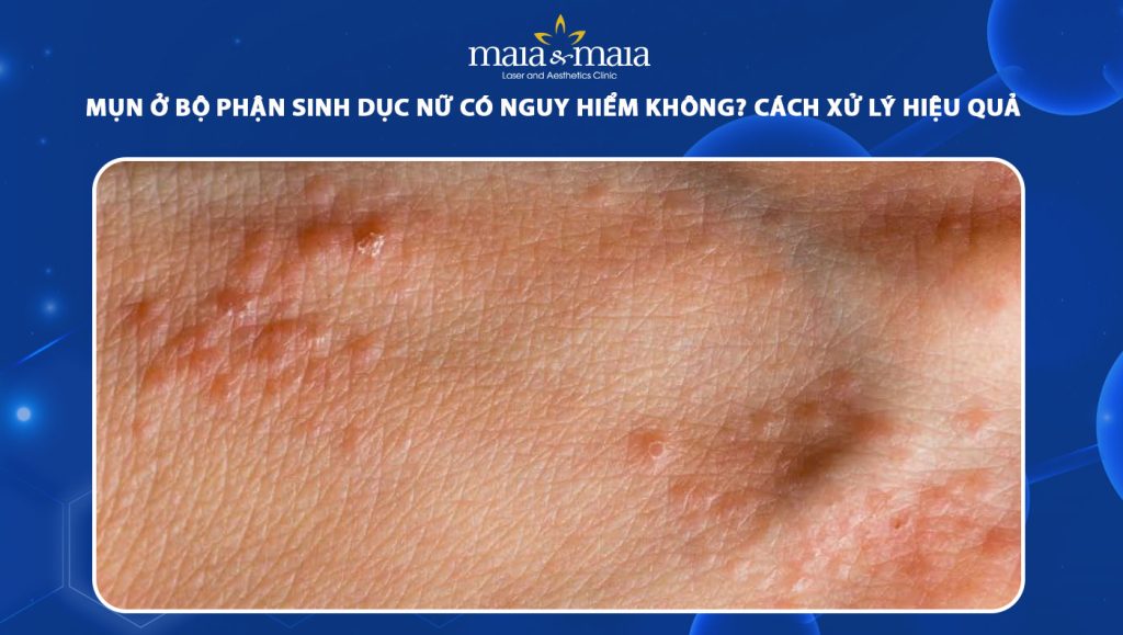 mụn ở bộ phận sinh dục nữ