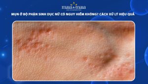 mụn ở bộ phận sinh dục nữ