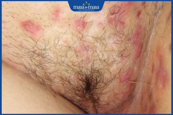 mụn ở vùng kín nữ