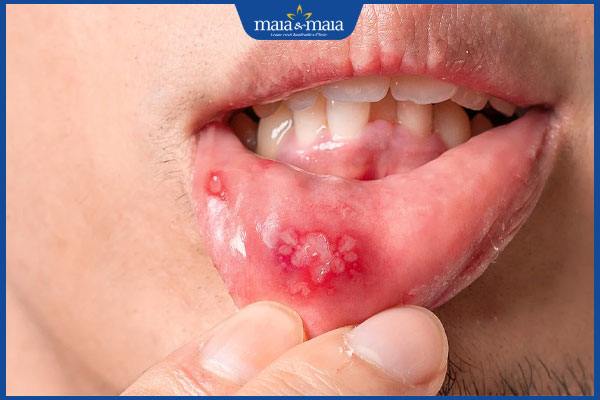 mụn rộp do nhiệt