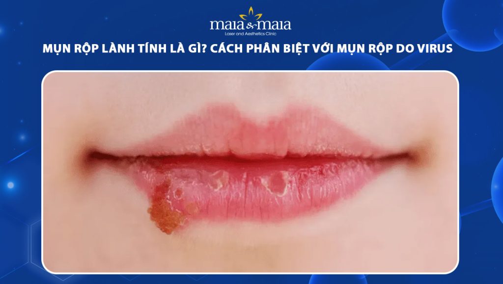 mụn rộp lành tính