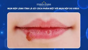 mụn rộp lành tính
