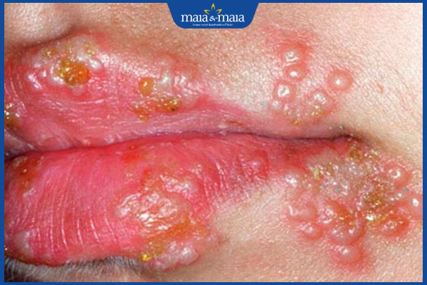 mụn rộp môi lây lan