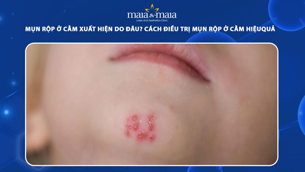 Mụn rộp ở cằm xuất hiện do đâu? Cách điều trị và phòng ngừa 1 mụn rộp ở cằm
