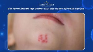 mụn rộp ở cằm