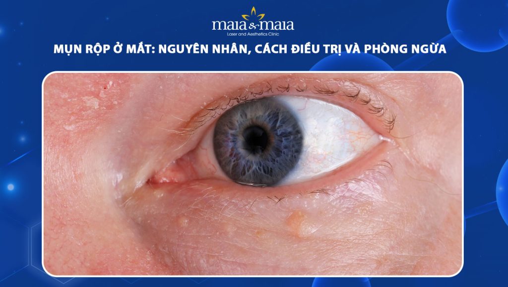 Mụn rộp ở mắt: Nguyên nhân, cách điều trị và phòng ngừa 1 mụn rộp ở mắt