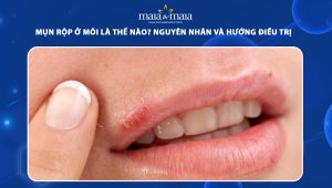 mụn rộp ở môi