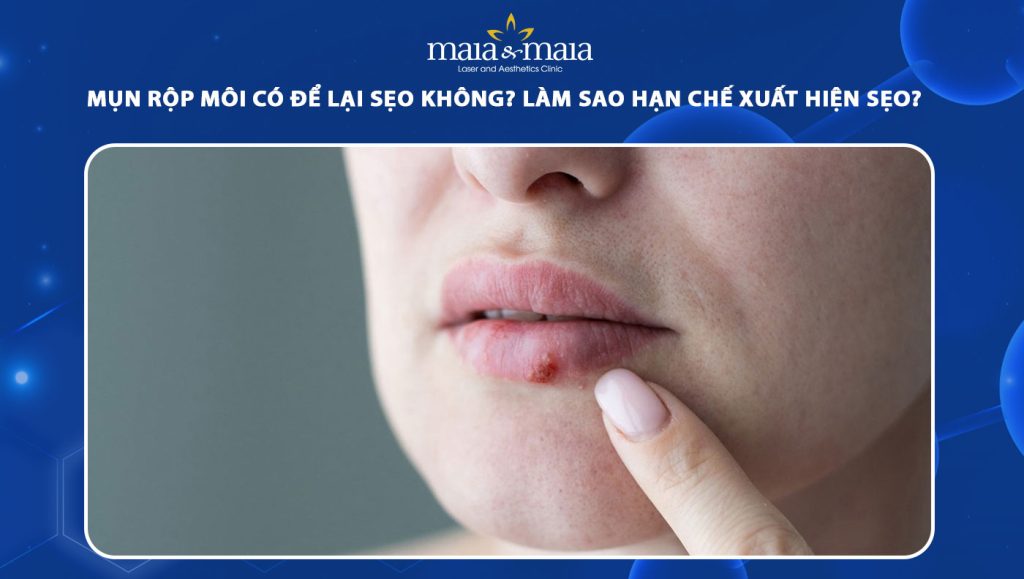 Mụn rộp môi có để lại sẹo không? Làm sao để hạn chế sẹo? 1 mụn rộp ở môi có để lại sẹo không