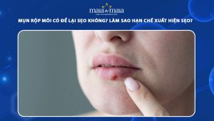 mụn rộp ở môi có để lại sẹo không