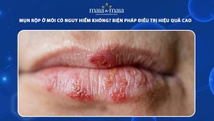 mụn rộp ở môi có nguy hiểm không