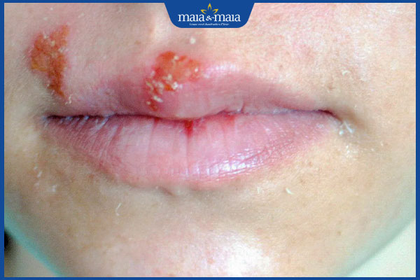 Mụn rộp môi có để lại sẹo không? Làm sao để hạn chế sẹo? 2 mụn rộp ở môi gây sẹo