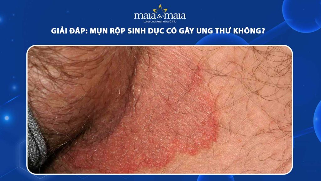 Giải đáp: Mụn rộp sinh dục có gây ung thư không? 1 mụn rộp sinh dục có gây ung thư không