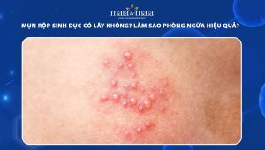 mụn rộp sinh dục có lây không