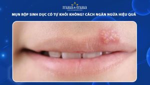 mụn rộp sinh dục có tự khỏi không