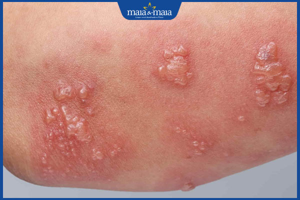 Mụn rộp sinh dục có lây không? Cách phòng ngừa hiệu quả 2 mụn rộp sinh dục lây lan