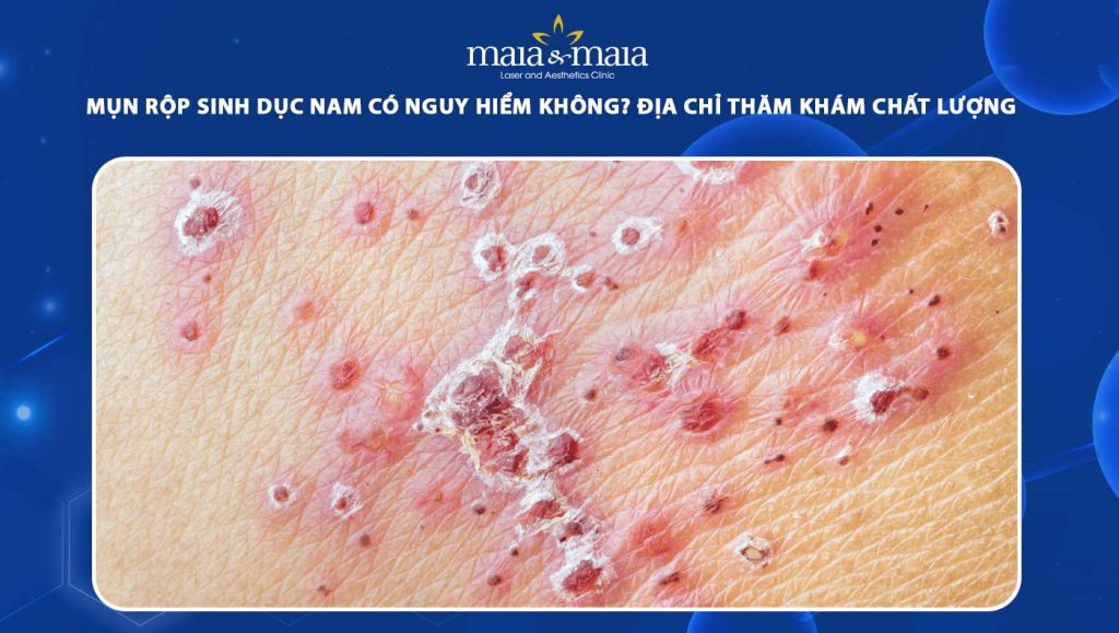 Mụn rộp sinh dục nam có nguy hiểm không? Điều trị ở đâu tốt? 1 mụn rộp sinh dục nam
