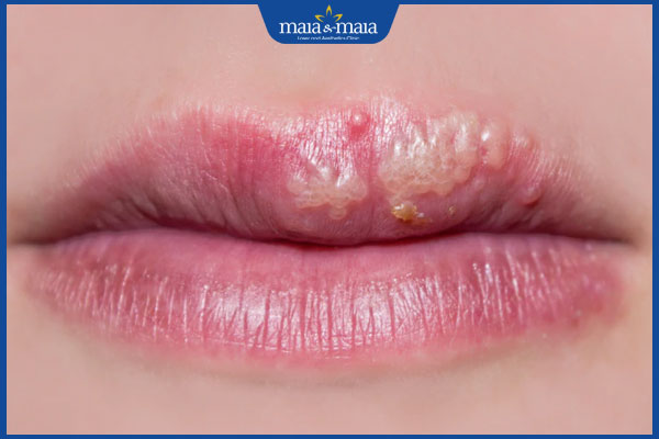 Mụn rộp sinh dục ở miệng có nguy hiểm không? 2 mụn rộp sinh dục nổi ở miệng