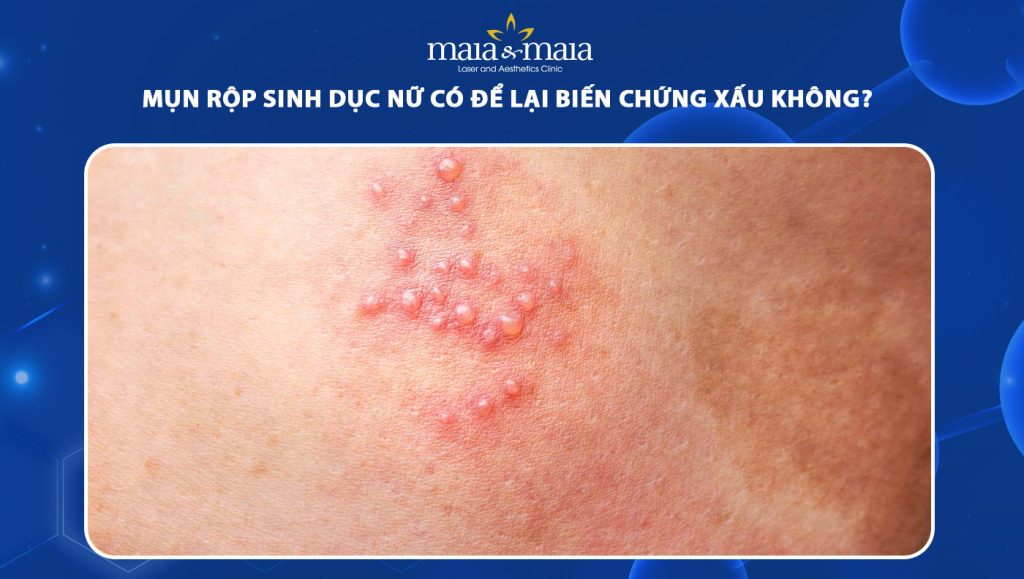 mụn rộp sinh dục nữ