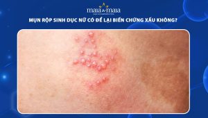 mụn rộp sinh dục nữ