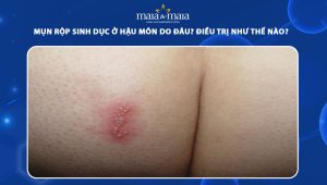 mụn rộp sinh dục ở hậu môn