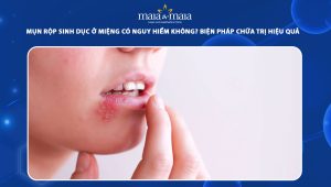 mụn rộp sinh dục ở miệng