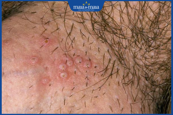 Giải đáp: Mụn rộp sinh dục có gây ung thư không? 2 mụn rộp sinh dục nam