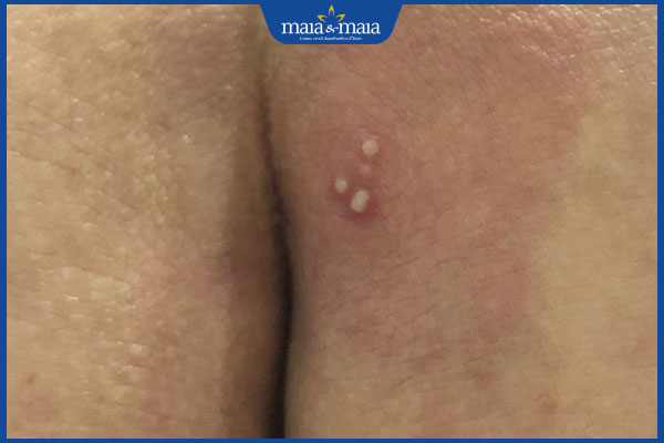 mụn rộp sinh dục ở nữ