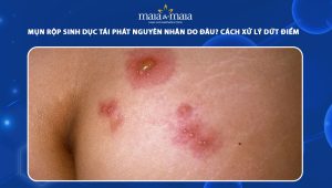 mụn rộp sinh dục tái phát
