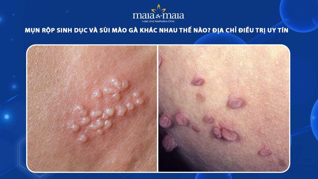 mụn rộp sinh dục và sùi mào gà