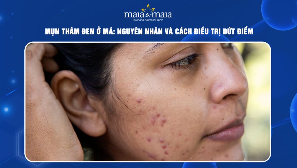 Mụn thâm đen ở má