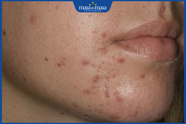 mụn thâm lâu năm