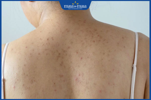 mụn thâm ở lưng