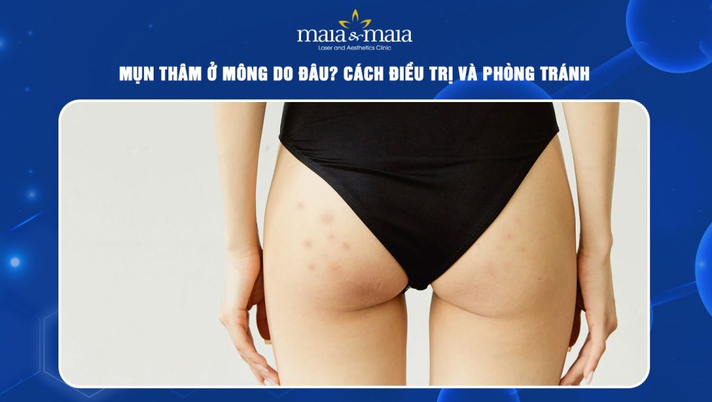 Mụn thâm ở mông