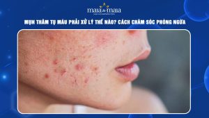 Mụn thâm tụ máu