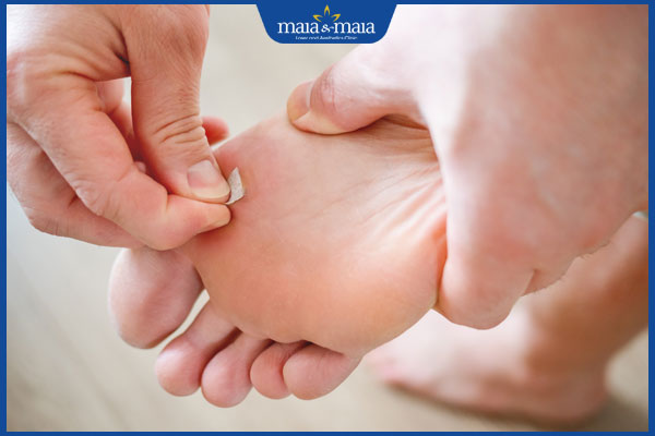 mụn thịt đóng vảy