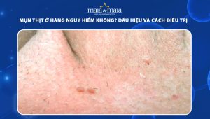 mụn thịt ở háng