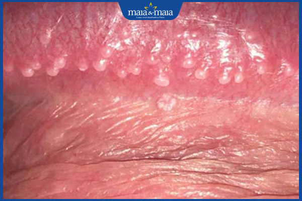 mụn trắng dương vật