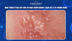 Mụn trắng ở bao quy đầu