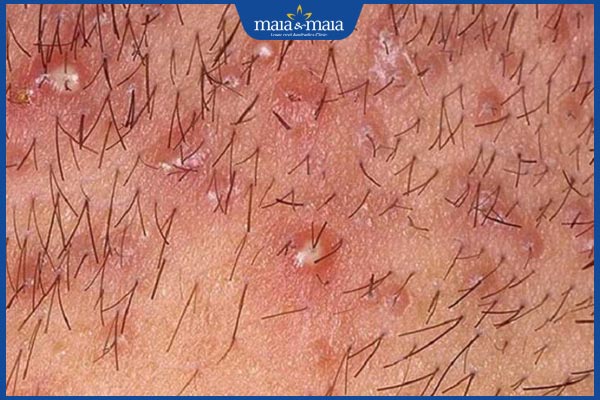 Mụn ở bộ phận sinh dục nam do đâu? Điều trị như thế nào? 2 mụn vùng kín nam