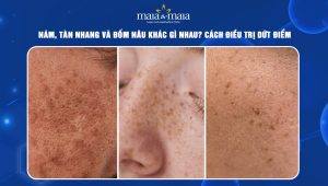 Nám, tàn nhang và đốm nâu