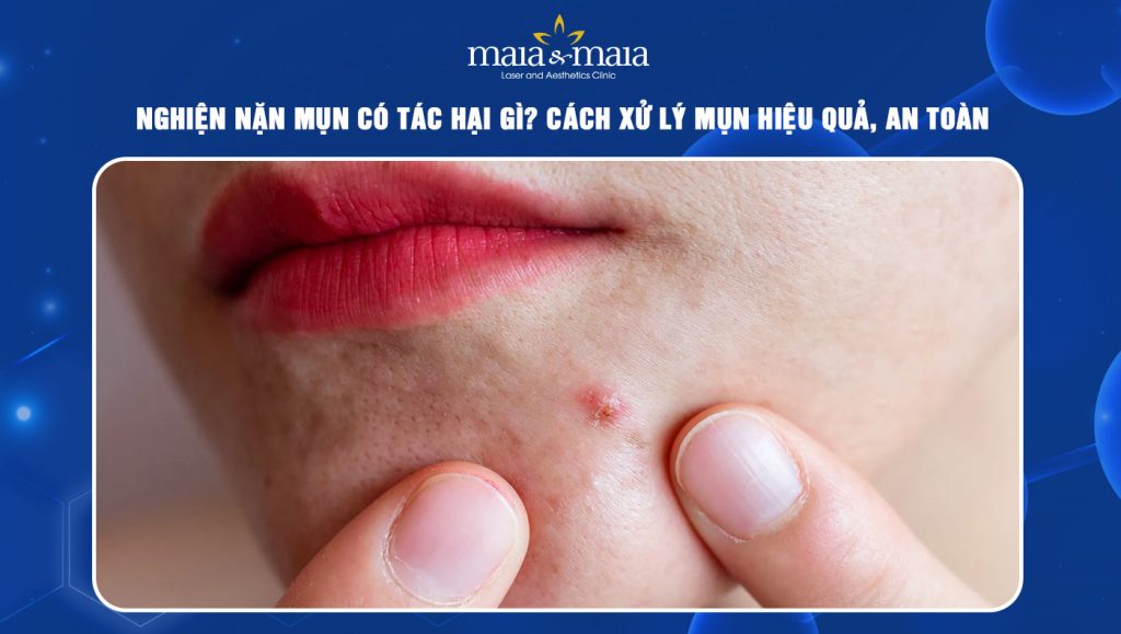 Nghiện nặn mụn có tác hại gì? Cách xử lý mụn an toàn 1 nghiện nặn mụn