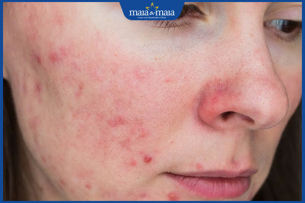 Omega 3 trị mụn nội tiết tốt không? Cách để bổ sung Omega 3 3 người bị mụn