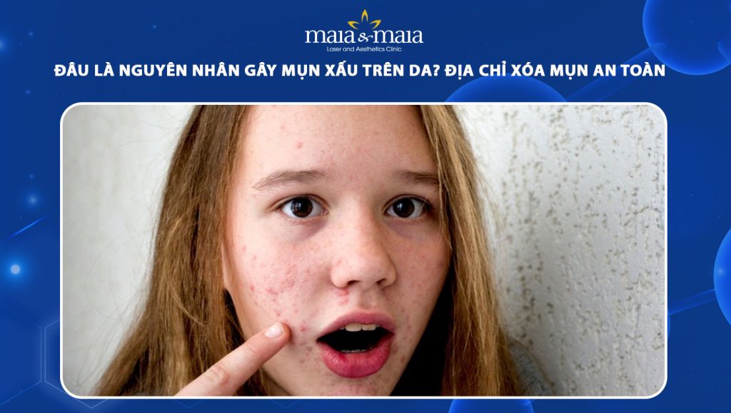 nguyên nhân gây mụn