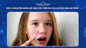 nguyên nhân gây mụn